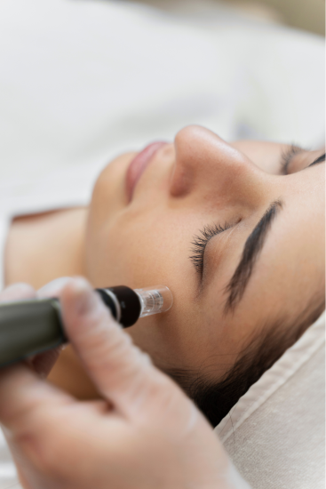 dermapen4_treatments_laval_and_boisbriand dermapen4_treatments_laval_and_boisbriand