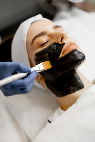 hollywood_carbon_peel_treatments_laval_and_boisbriand