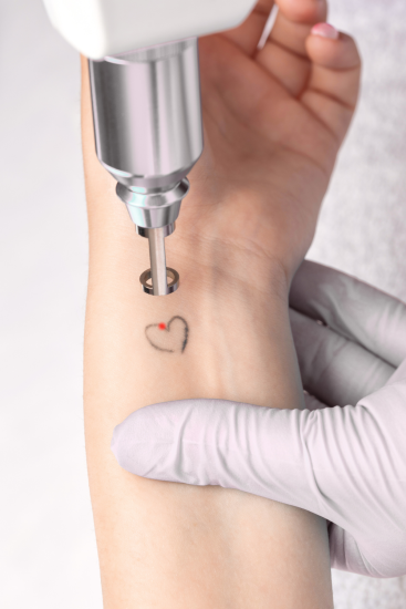 laser_tattoo_removal_treatments_laval_and_boisbriand