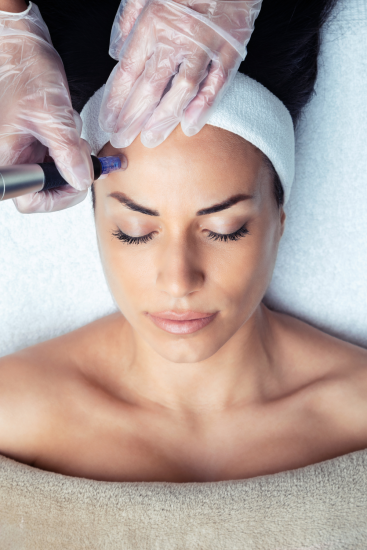 microneedling_treatments_laval_and_boisbriand microneedling_treatments_laval_and_boisbriand