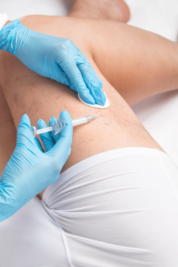 spider-vein_removal_treatments_laval_and_boisbriand